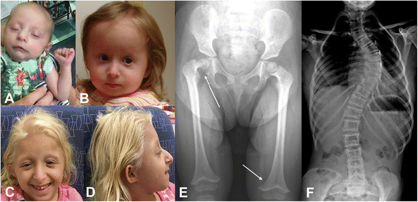 primordial dwarfism mopd type 1