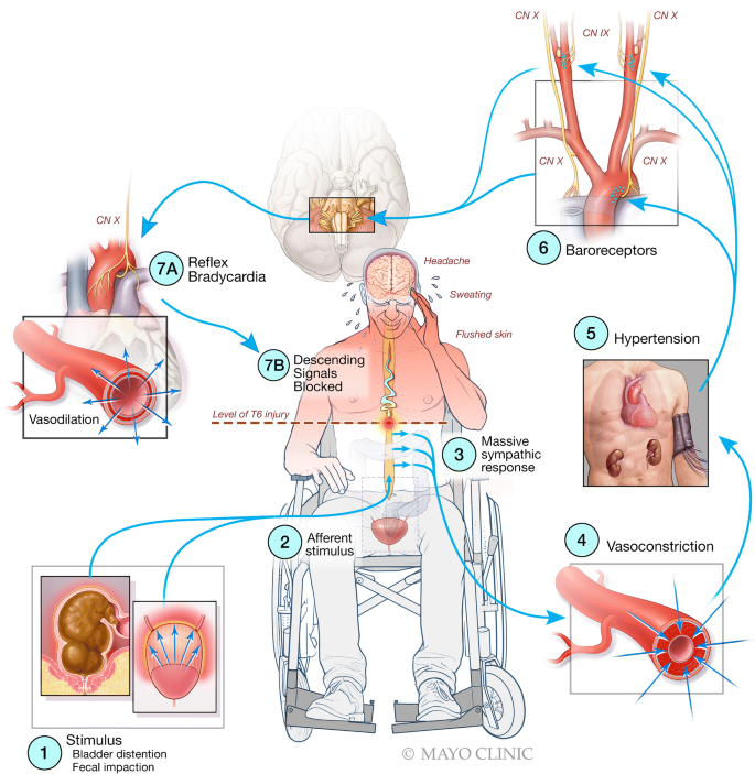 Signs and symptoms of autonomic dysreflexia