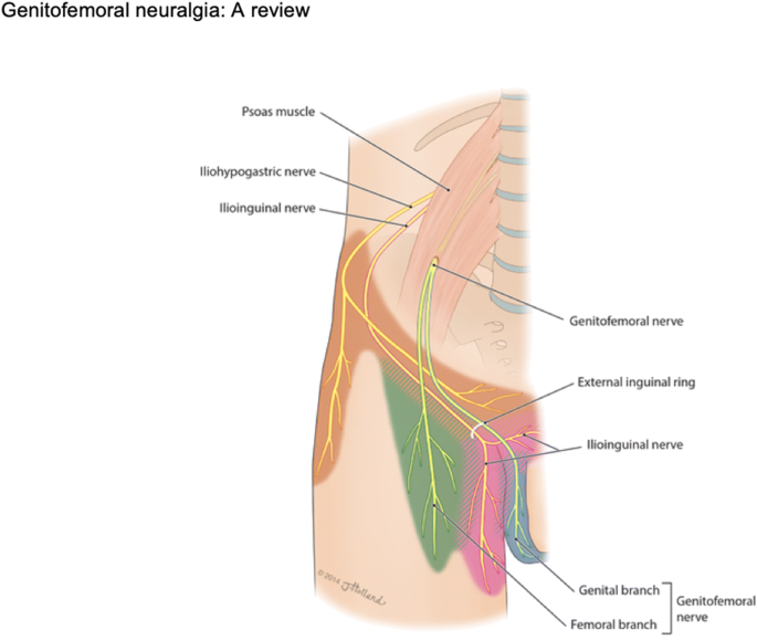 Ilioinguinal Neuropathy Springerlink