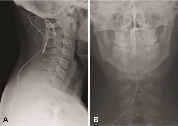 Cervical Spinal Cord Stimulation for Trigeminal Neuralgia: a Narrative  Review | SpringerLink