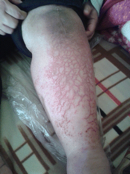 Drug Reaction With Eosinophilia And Systemic Symptoms Dress Syndrome And The Rheumatologist Springerlink Drug Reaction With Eosinophilia And Systemic Symptoms Dress Syndrome And The Rheumatologist Springerlink