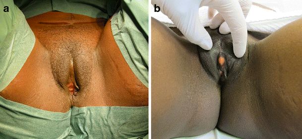 Vaginal Reconstruction With Pedicled Vertical Deep Inferior Epigastric Perforator Flap