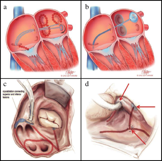 Atrial Fibrillation Ablation: Indications and Techniques | SpringerLink