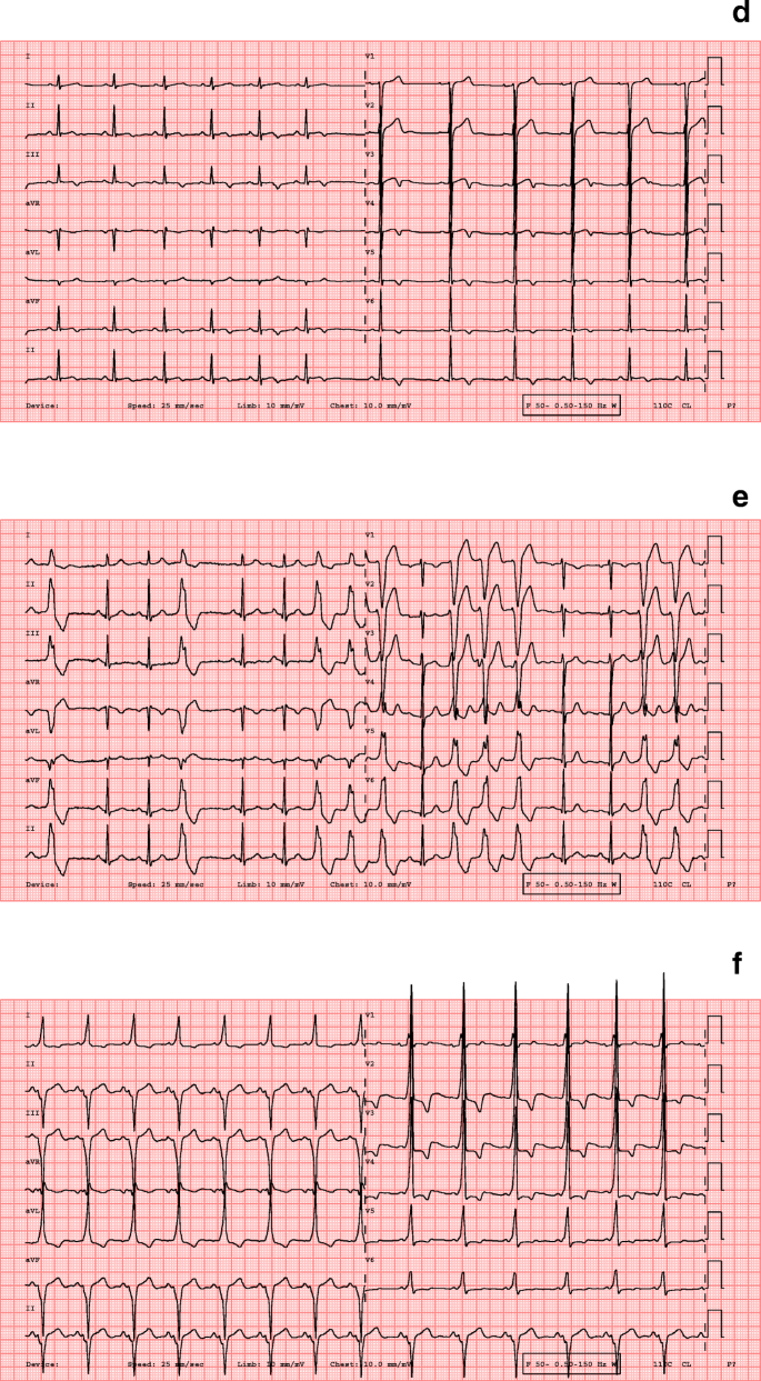 Abnormal ECG Findings in Athletes: Clinical Evaluation and Considerations |  Current Treatment Options in Cardiovascular Medicine