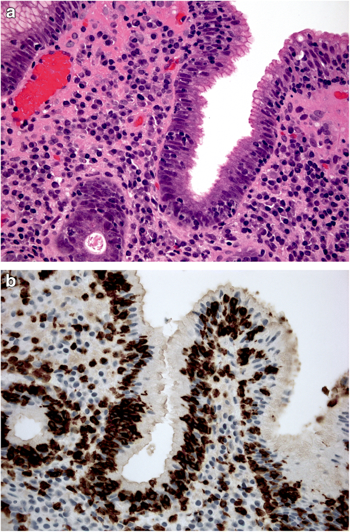 Gastritis An Update In 2020 Springerlink Gastritis An Update In 2020 Springerlink
