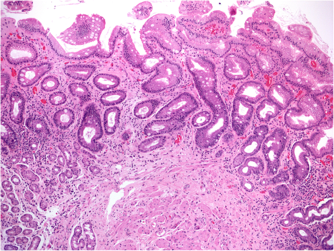 Gastric antrum biopsy