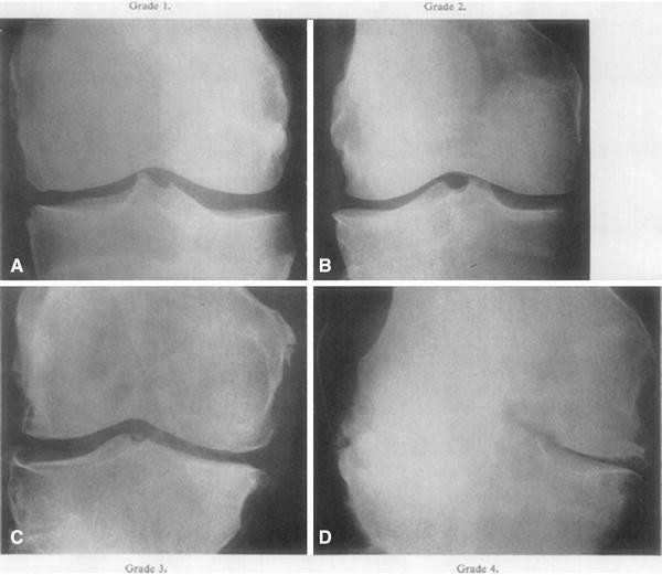 osteoarthritis knee kellgren lawrence)