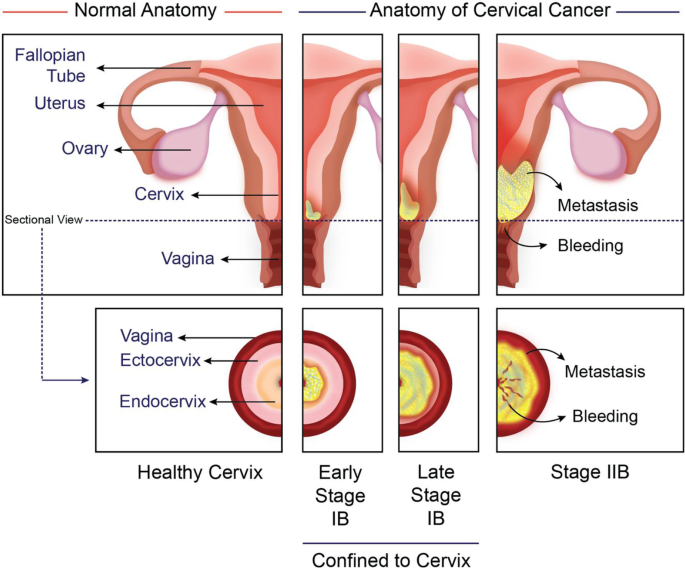 Cervical Ectropion | CUH