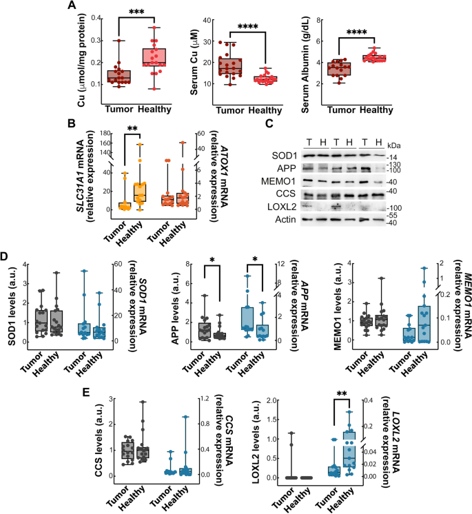 Copper Dysmetabolism Is Connected To Epithelial-mesenchymal Transition 