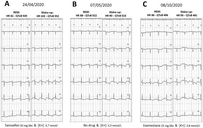 When Manual Analysis of 12-Lead ECG Holter Plays a Critical Role in  Discovering Unknown Patterns of Increased Arrhythmogenic Risk: A Case  Report of a Patient Treated with Tamoxifen and Subsequent Pneumonia in