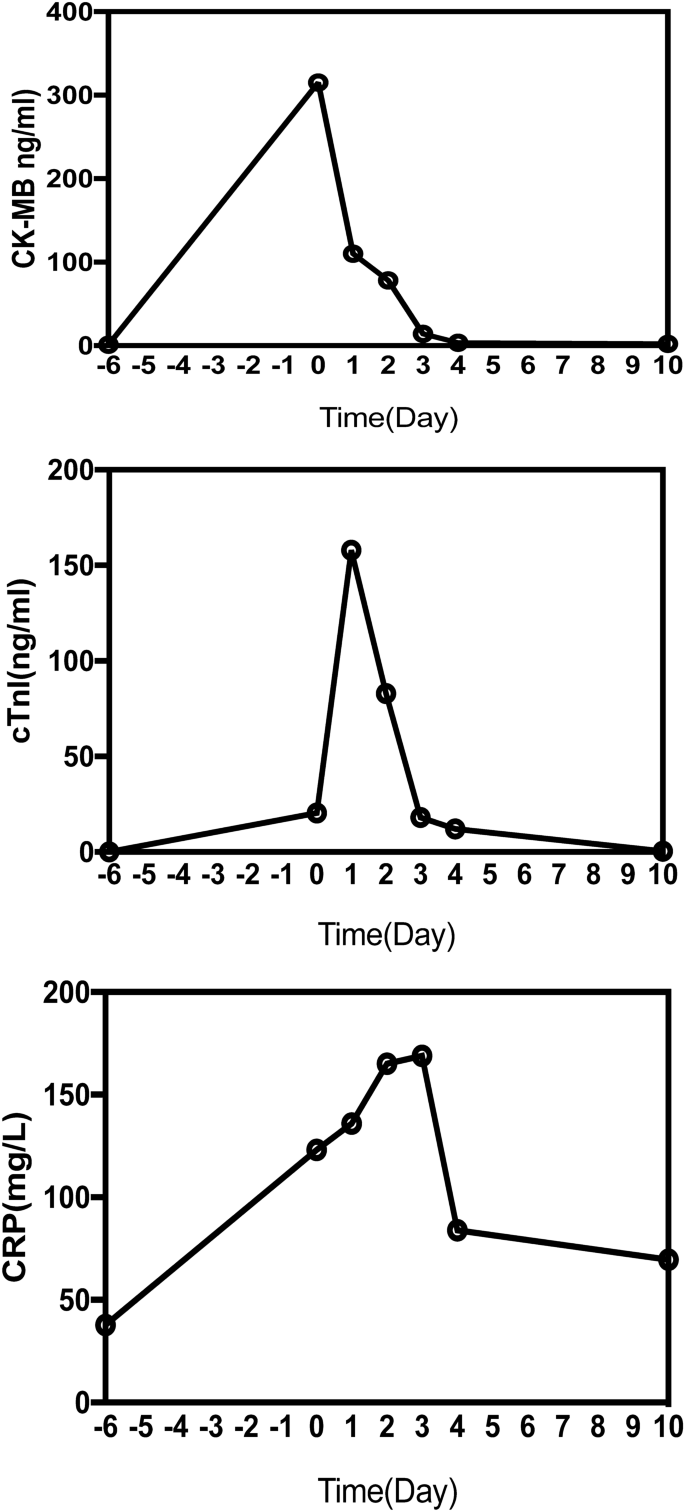 Early Onset Acute Coronary Artery Occlusion After Pembrolizumab In Advanced Non Small Cell Lung Cancer A Case Report Springerlink
