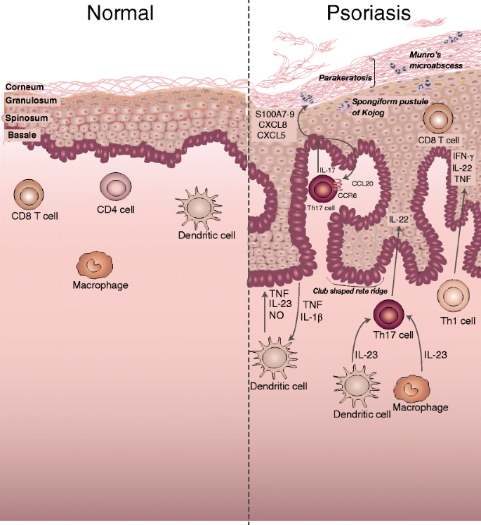 psoriasis and immune system)