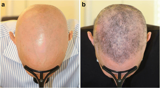Alopecia Areata: a Comprehensive Review of Pathogenesis and Management |  SpringerLink