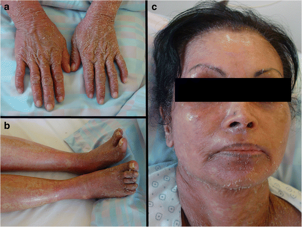 Skin Manifestations Associated with Autoimmune Liver Diseases: a Systematic  Review | SpringerLink