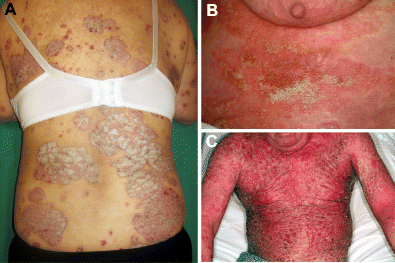 psoriasis перевод)