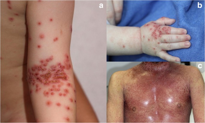 Eczema Herpeticum Clinical And Pathophysiological Aspects Springerlink Eczema Herpeticum Clinical And Pathophysiological Aspects Springerlink