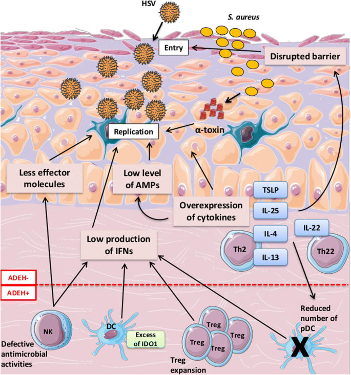 Eczema Herpeticum Clinical And Pathophysiological Aspects Springerlink