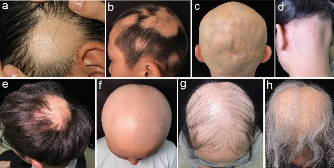 Alopecia Areata: an Update on Etiopathogenesis, Diagnosis, and Management | SpringerLink Alopecia Areata: an Update on Etiopathogenesis, Diagnosis, and Management | SpringerLink