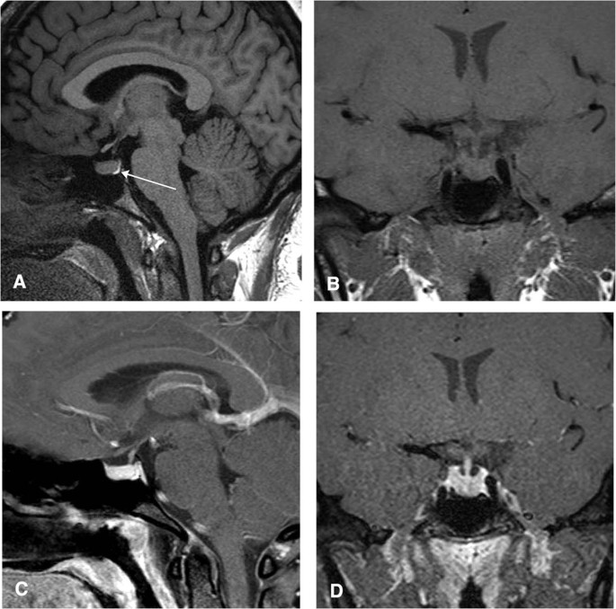 Diagnosis and Management of pituitary disease with focus on the role of Magnetic  Resonance Imaging | SpringerLink
