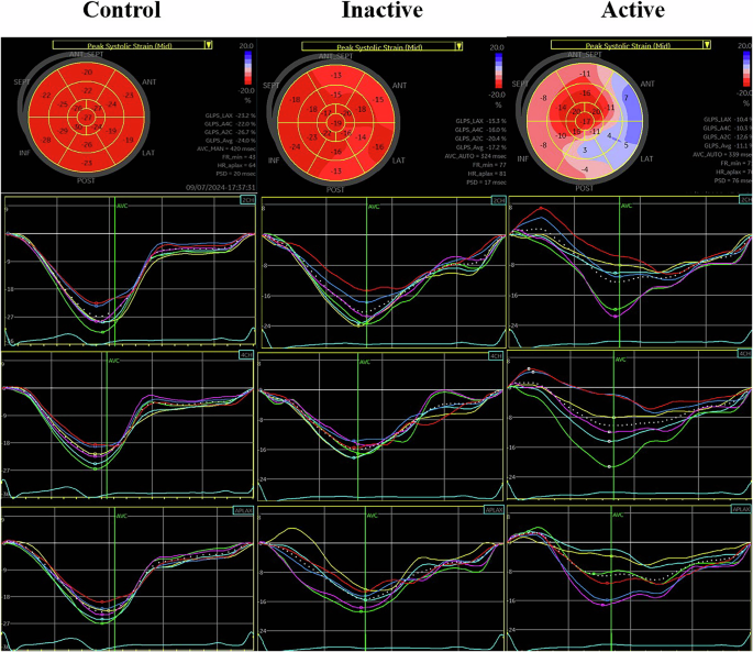 Left ventricular subclinical systolic myocardial dysfunction assessed ...