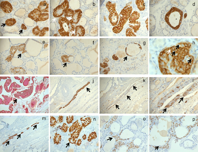 Thyroid Solid Cell Nests Usefulness Of Cytokeratin 5 6 Springerlink