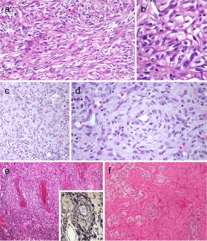 Pitfalls in Challenging Thyroid Tumors: Emphasis on Differential Diagnosis  and Ancillary Biomarkers | SpringerLink