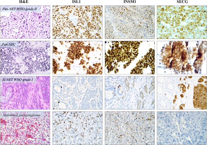 Clinical Routine Application of the Second-generation Neuroendocrine Markers  ISL1, INSM1, and Secretagogin in Neuroendocrine Neoplasia: Staining  Outcomes and Potential Clues for Determining Tumor Origin | SpringerLink