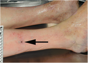 ruptured varicose vein ruptured varicose vein