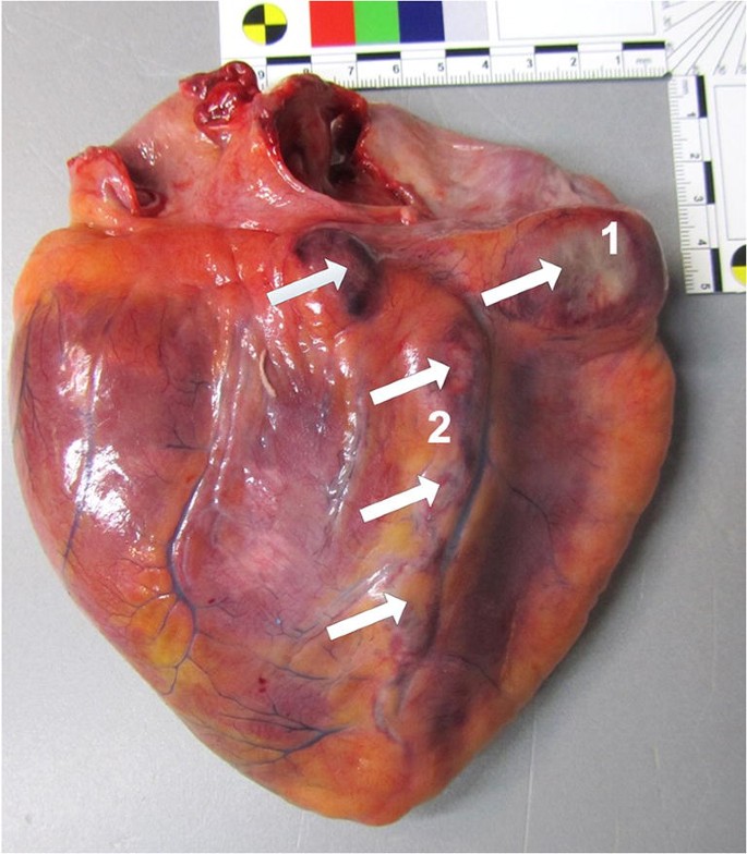 Sudden death of a young adult with coronary artery vasculitis, coronary  aneurysms, parvovirus B19 infection and Kawasaki disease | SpringerLink
