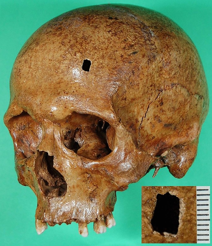 Were mystery holes in skulls an ancient aspirin?