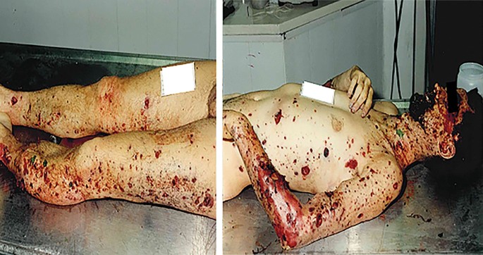 Explosion-related deaths: An overview on forensic evaluation and  implications | SpringerLink