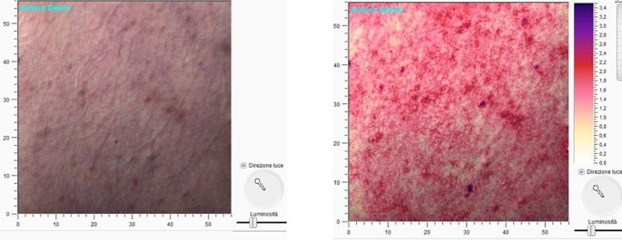 Spectrophotometric evaluation of postmortem lividity: a proposal 