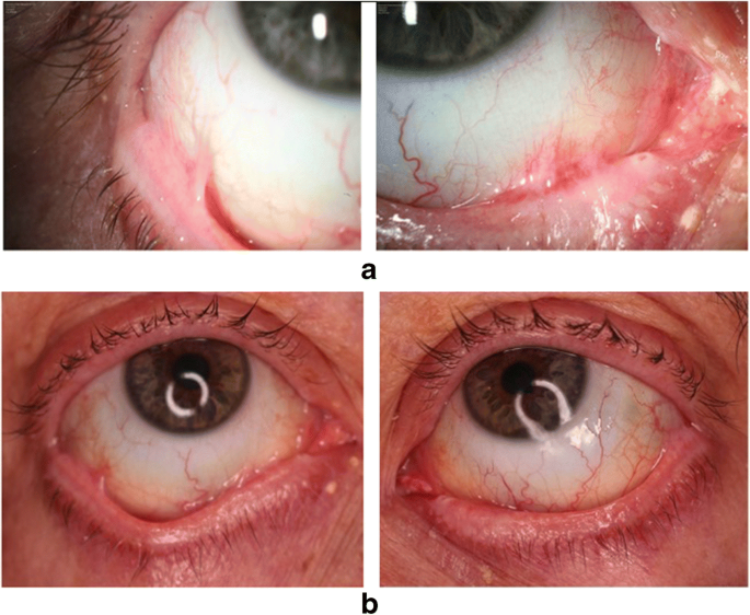 Ocular mucous membrane pemphigoid: a review | SpringerLink