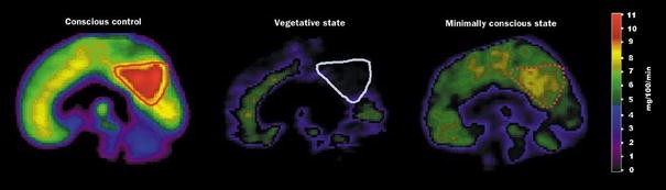 Cognitive Event Related Potentials In Comatose And Post Comatose States Springerlink