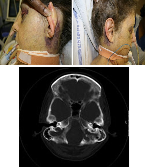 False-Positive Presentation of Battle's Sign During Hepatic Encephalopathy | SpringerLink False-Positive Presentation of Battle's Sign During Hepatic Encephalopathy | SpringerLink