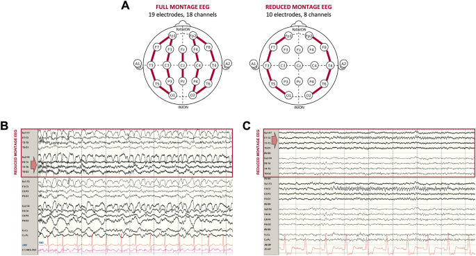 Midline And Parasagittal Seizures Are Rare In Adult Patients Springerlink