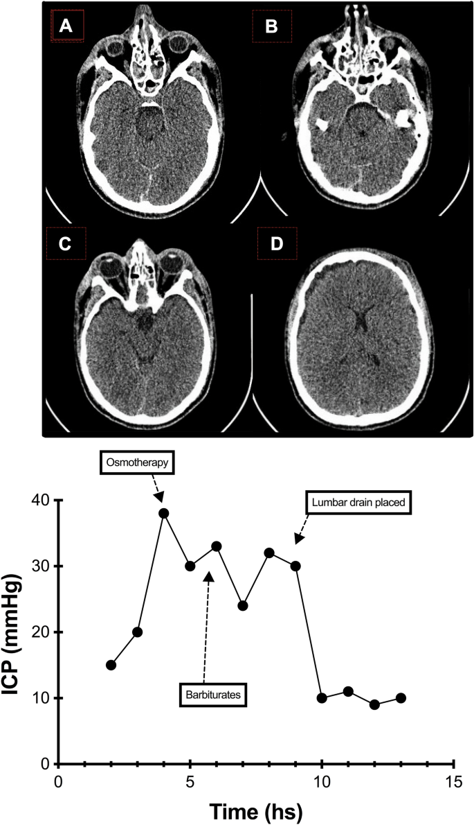 Intracranial Hypertension with Patent Basal Cisterns: Controlled