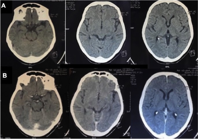 Intracranial Hypertension with Patent Basal Cisterns: Controlled