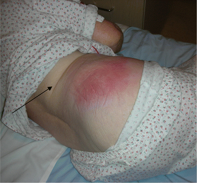 Right Gluteal Abscess: An Unusual Presentation of Perforated 