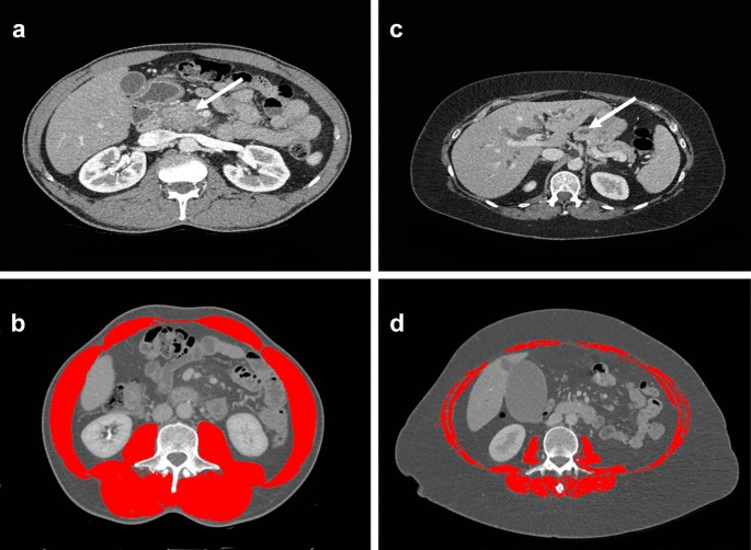 Impact of Sarcopenia on Outcomes Following Resection of Pancreatic  Adenocarcinoma