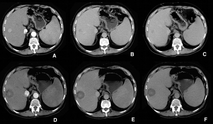 Percutaneous US-guided MWA of small liver HCC: predictors of outcome and  risk factors for complications from a single center experience |  SpringerLink