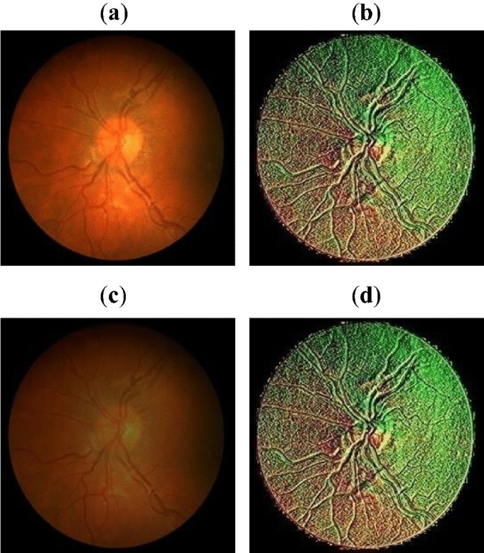 Retinal blood vessel detection using deep learning with texture ...