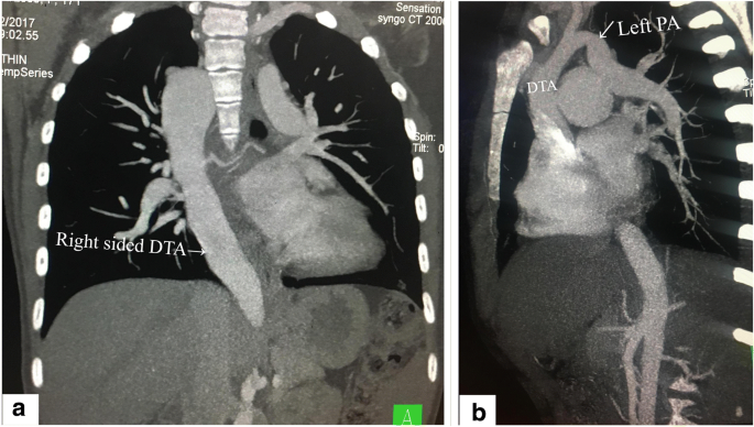 Right Sided Aortic Arch With Aortic Origin Of Left Pulmonary Artery And Patent Ductus Arteriosus A Rare Combination Of Aortic Arch Anomalies Springerlink
