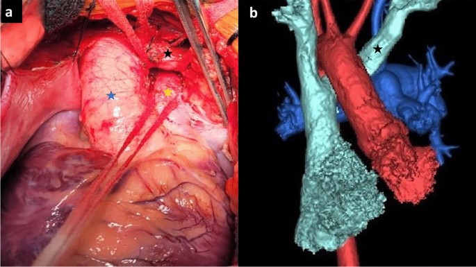 Braz J Cardiovasc Surg - The pulmonary vascular blood supply in