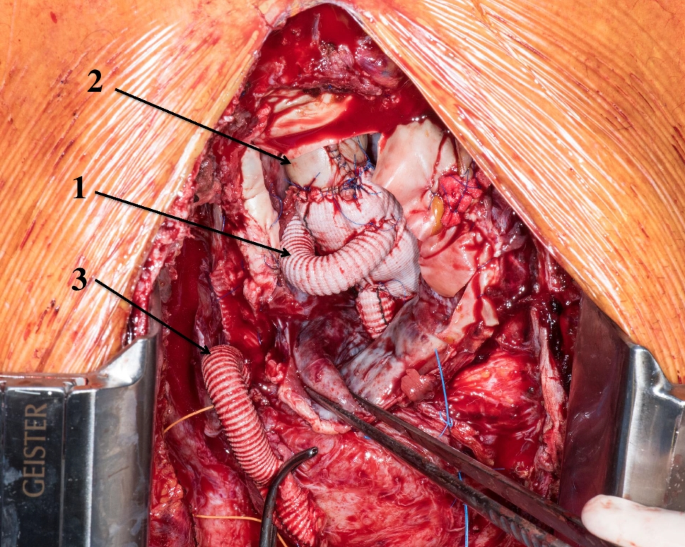 Significance and current approaches to vascular graft infection