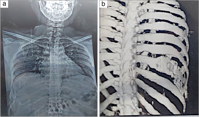 Osteofibrous dysplasia of the 8th rib: a case report | Indian Journal ...