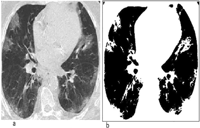 ALMAG-02 – lung recovery after pneumonia incl. COVID19