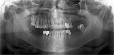 Asymptomatic Radio Opacity At The Floor Of Nasal Cavity Springerlink