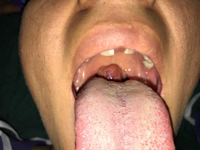 Papillary Thyroid Carcinoma with Cervical Lymph Node Metastasis Arising  from Lingual Thyroid | SpringerLink