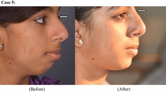 Non-surgical Rhinoplasty and Use of Hyaluronic Acid Based Dermal Filler-User  Experience in Few Subjects | SpringerLink